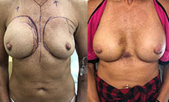 Breast Deflation Before and After