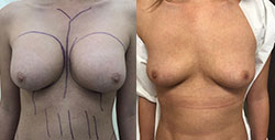 Breast Procedures Patient Before & After Photo 1