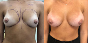 Breast Procedures Patient Before & After Photo 1