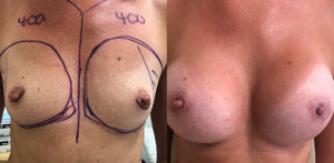 Breast Procedures Patient Before & After Photo 1