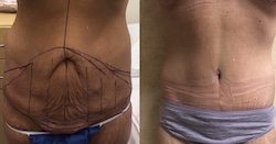 Body Procedures Patient Before & After Photo 1