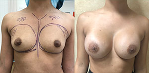 Breast Augmentation Before and After Photos