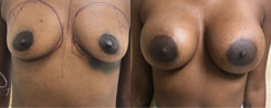 African American Breast Implants Patient Before & After Photo 1