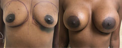 Breast Augmentation Patient Before & After Photo 1