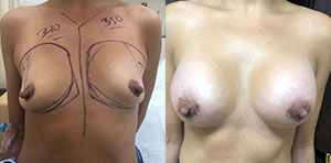 Breast augmentation before and after with 340/350cc implants performed in Beverly Hills