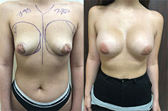 Tubular Breast Deformity Patient Before & After Photo 1