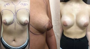 Tuberous Breasts Before and After