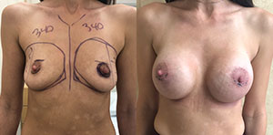 Breast Procedures Patient Before & After Photo 1