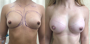 Breast Augmentation Patient Before & After Photo 1