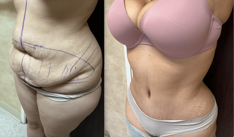 Before and after image showing the results of a tummy tuck performed in Beverly Hills, CA.