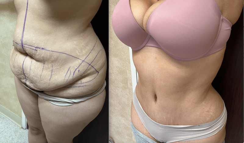 TUMMY TUCK REVISION  Dr. Stuart A. Linder