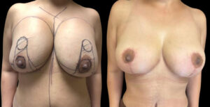 Implant removal