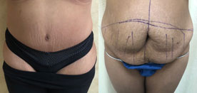 Tummy Tuck Patient Before & After Photo 1