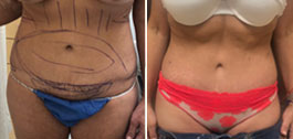 Body Procedures Patient Before & After Photo 1