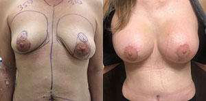 Breast Lift Patient Before & After Photo 1