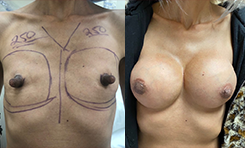 Breast Augmentation Patient Before & After Photo 1