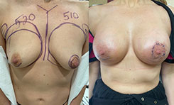 Tubular Breast Deformity Patient Before & After Photo 1