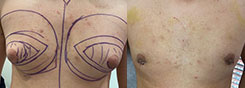 Procedures for Men Patient Before & After Photo 1