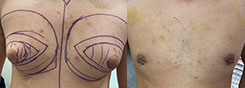 Gynecomastia Patient Before & After Photo 1