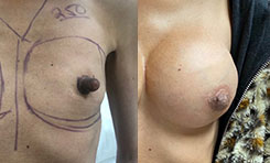 Nipple Reduction Patient Before & After Photo 1