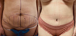 Liposuction Patient Before & After Photo 1