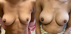 Patient Breast Augmentation Results