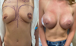 Patient Breast Augmentation Results