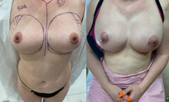 Breast Procedures Patient Before & After Photo 1