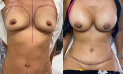 Breast Augmentation Patient Before & After Photo 1