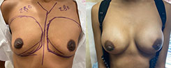 Breast Augmentation Patient Before & After Photo 1