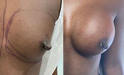 Breast Procedures Patient Before & After Photo 1