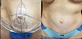 Body Procedures Patient Before & After Photo 1