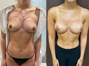 Breast Augmentation Patient Before & After Photo 1