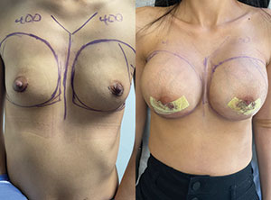 Breast Augmentation Patient Before & After Photo 1