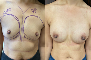 Breast Augmentation Patient Before & After Photo 1