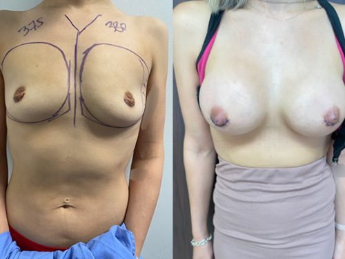 Breast Procedures Patient Before & After Photo 1