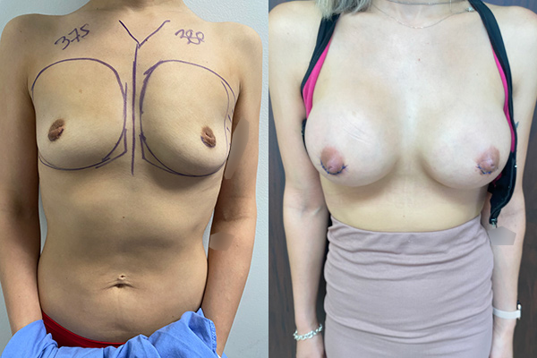 Breast augmentation before and after with 375cc implants performed in Beverly Hills