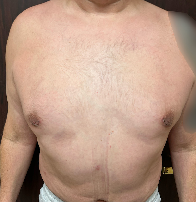 Man four weeks after his gynecomastia surgery in Beverly Hills.