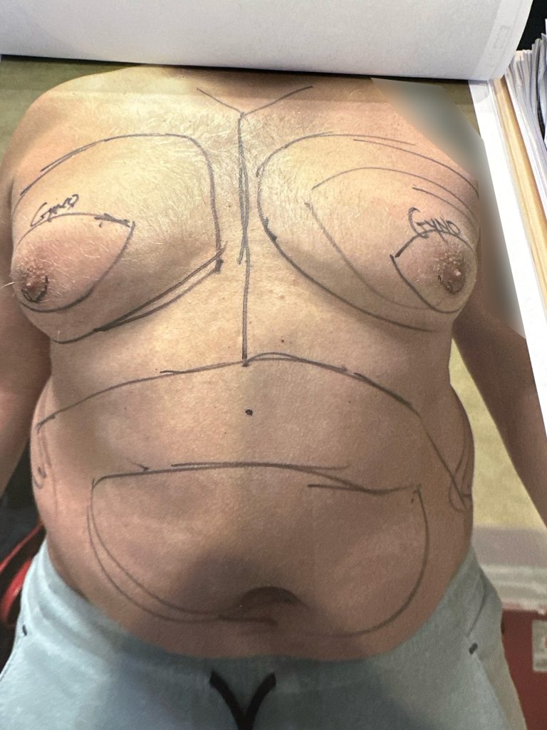 Man before his gynecomastia surgery in Beverly Hills.