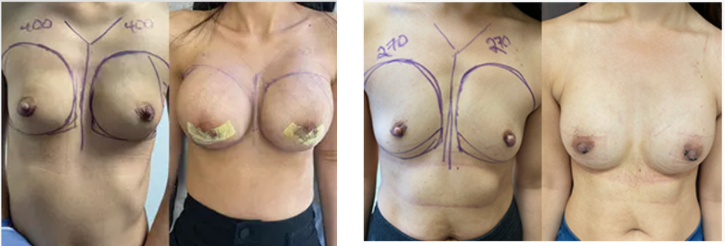 Breast augmentation before and after examples performed in Beverly Hills