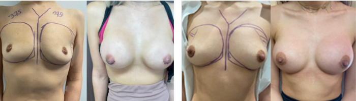 Breast augmentation before and after performed in Beverly Hills