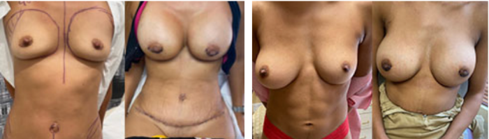Breast augmentation before and after performed in Beverly Hills