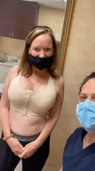 Breast augmentation patient one week after her surgery in Beverly Hills.