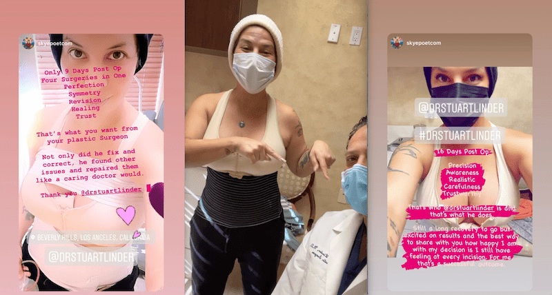 A woman's social media post explaining her breast surgery process with Dr. Linder.