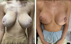 Breast Procedures Patient Before & After Photo 1