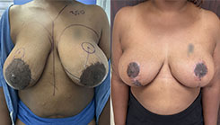 Breast Procedures Patient Before & After Photo 1