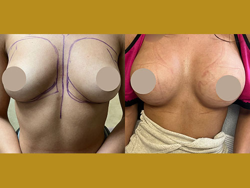 Breast Augmentation Patient Before & After Photo 1