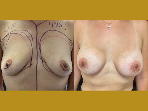 Breast Procedures Patient Before & After Photo 1