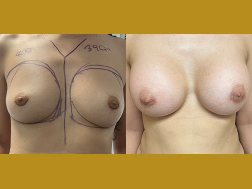 Breast Augmentation Patient Before & After Photo 1