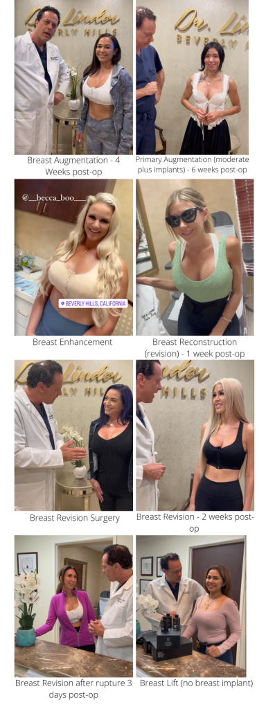 Breast enhancement patients in Beverly Hills after their procedures.